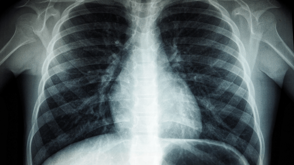 AI Revolutionizes Chest X-rays for Heart Disease Diagnosis